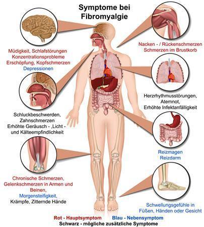 Fibromyalgie_Symptome_400x450